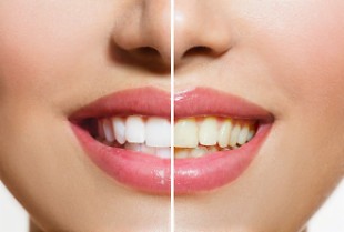 Tại sao răng chúng ta bị ố vàng? – VnReview